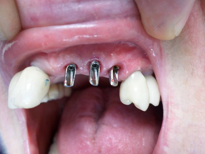 Implants dentaires avec mise en charge immédiate Genève 