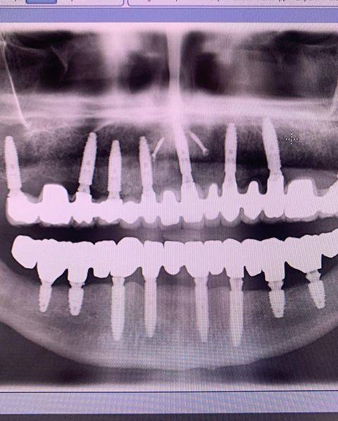 Implants dentaires à Genève