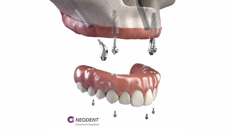 Solution immédiate de pose d'implants dentaires à Genève lors d'atrophie sévère du maxillaire
