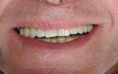 Pose d'implants dentaires Nasalus à Genève en Suisse