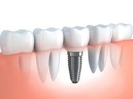 Implants dentaire Suisse