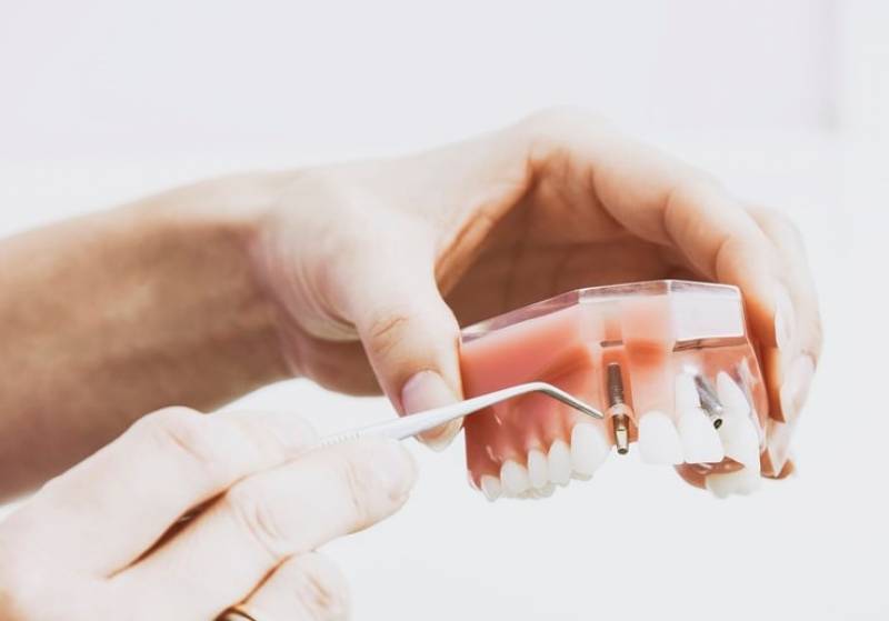 Implants dentaires à genève