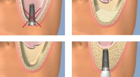Un implant dentaire impossible à fixer dans le sinus(cavité) fig(2) la muqueuse sinusienne est réclinée délicatement- (fig3)inse